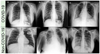 Explainable Machine Learning for COVID-19 Pneumonia Classification With Texture-Based Features Extraction in Chest Radiography